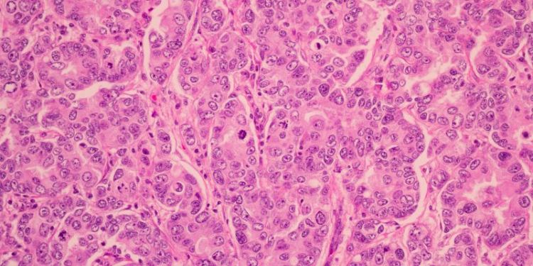 Using AI to detect cancer from patient data securely