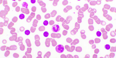 Chronic Lymphocytic Leukemia microscope analysis