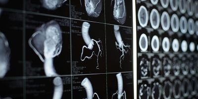 Human heart and coronary artery images representing our research