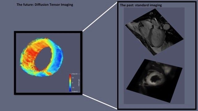 Heart study