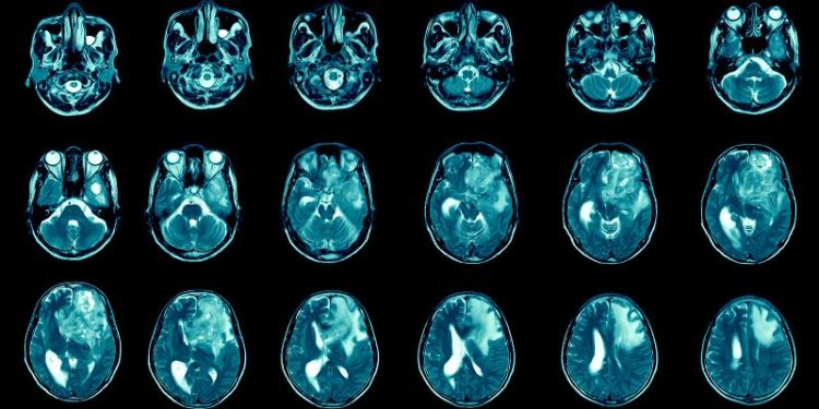 Novel approach to brain tumour treatment