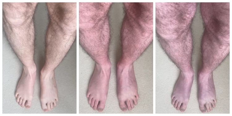 Raising awareness of Long Covid 'blue legs' symptom